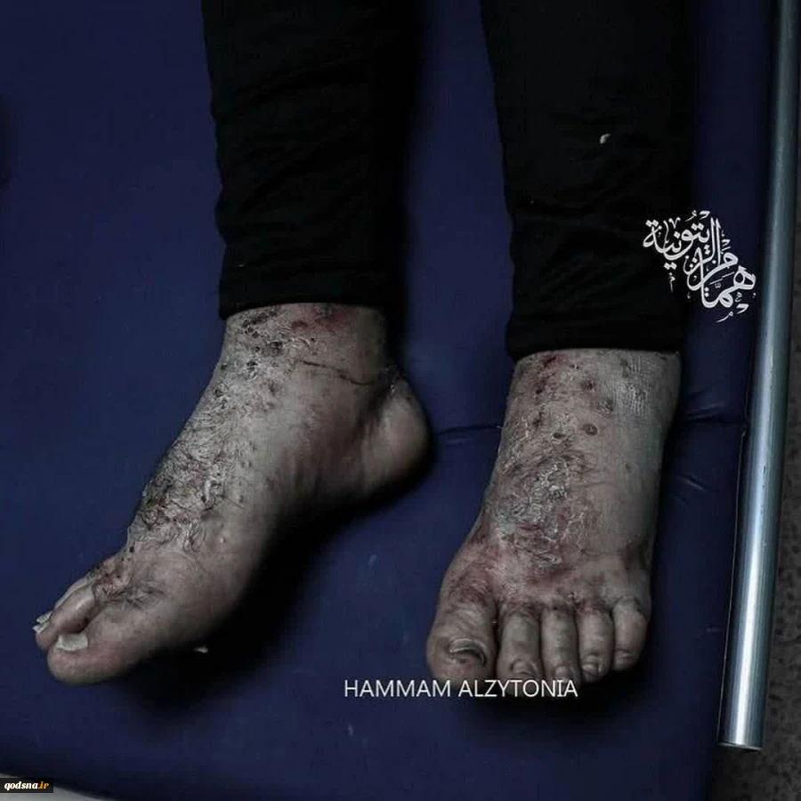 آثار شکنجه روی بدن اسیر آزاد شده وائل جمعه 3