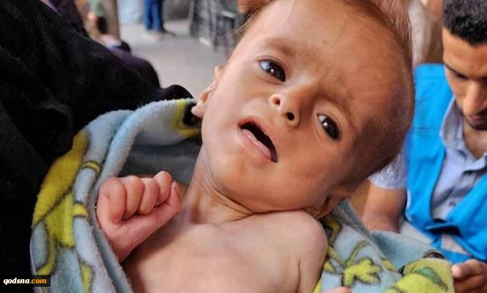 منابع پزشکی فلسطینی گزارش دادند:
سوءتغذیه شدید ۱۷ هزار کودک فلسطینی/ یک کودک شیرخواره دیگر شهید شد 2