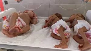 منابع پزشکی فلسطینی گزارش دادند:
سوءتغذیه شدید ۱۷ هزار کودک فلسطینی/ یک کودک شیرخواره دیگر شهید شد 2