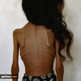 Child Muhammad Khader dies of hunger in Khan Yunis