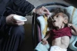 فاجعه انسانی در غزه: ۵۴ هزار کودک زیر پنج سال قربانی سوءتغذیه حاد 2
