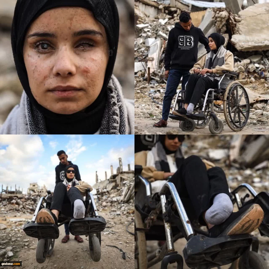 از دست دادن بینایی یک دختر 17 ساله فلسطینی در حمله رژیم صهیونیستی 2